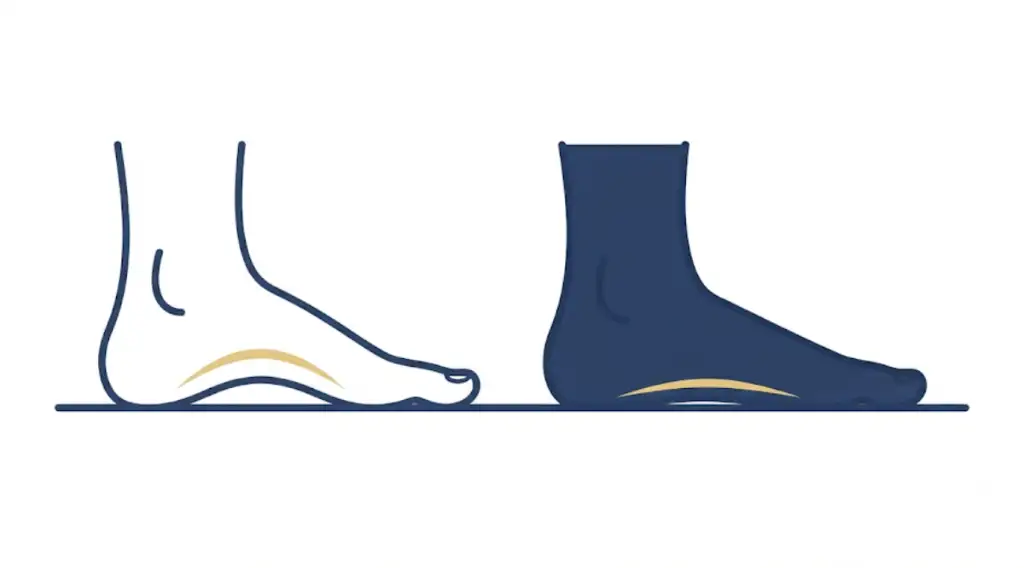 Biomechanical vector diagram comparing a normal foot arch with a collapsed flat foot arch and overpronation